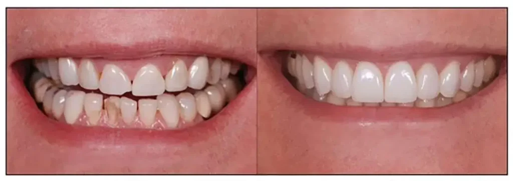smile transformation 1