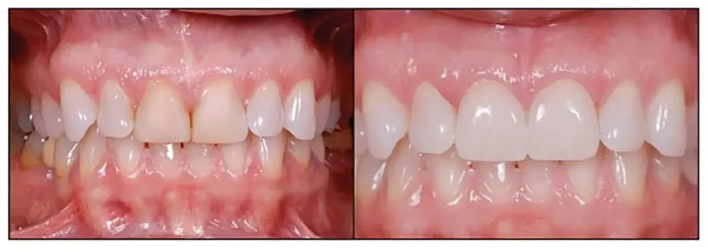 smile transformation 2