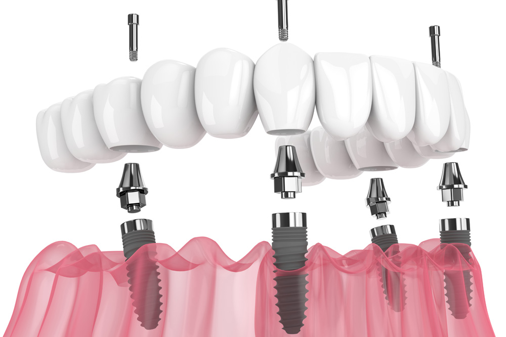 all on 4 system supported by implants