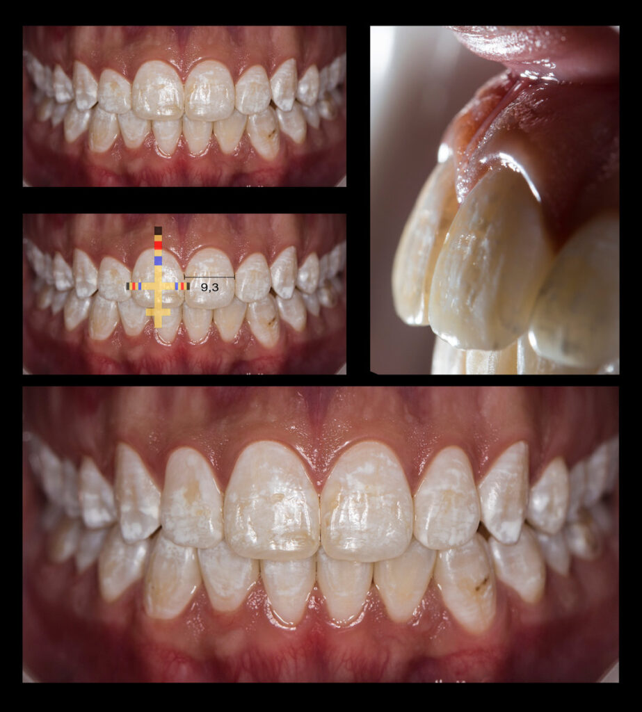 Esthetic and Photographic Analysis of a Smile with Enamel Hypomineralization