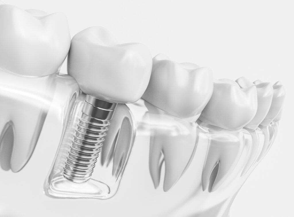 Tooth human implant - 3D Rendering