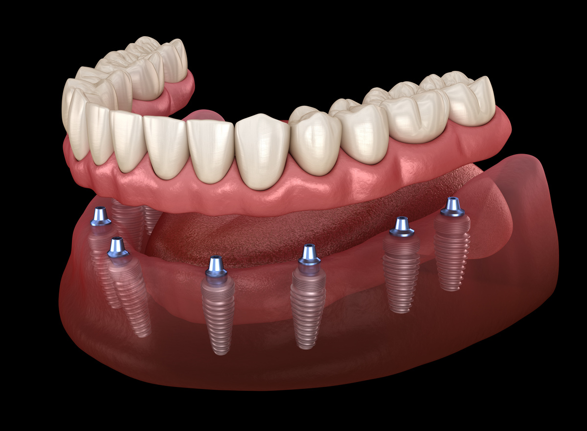Mandibular prosthesis All on 8 system supported by implants. Medically accurate 3D illustration of human teeth and dentures concept