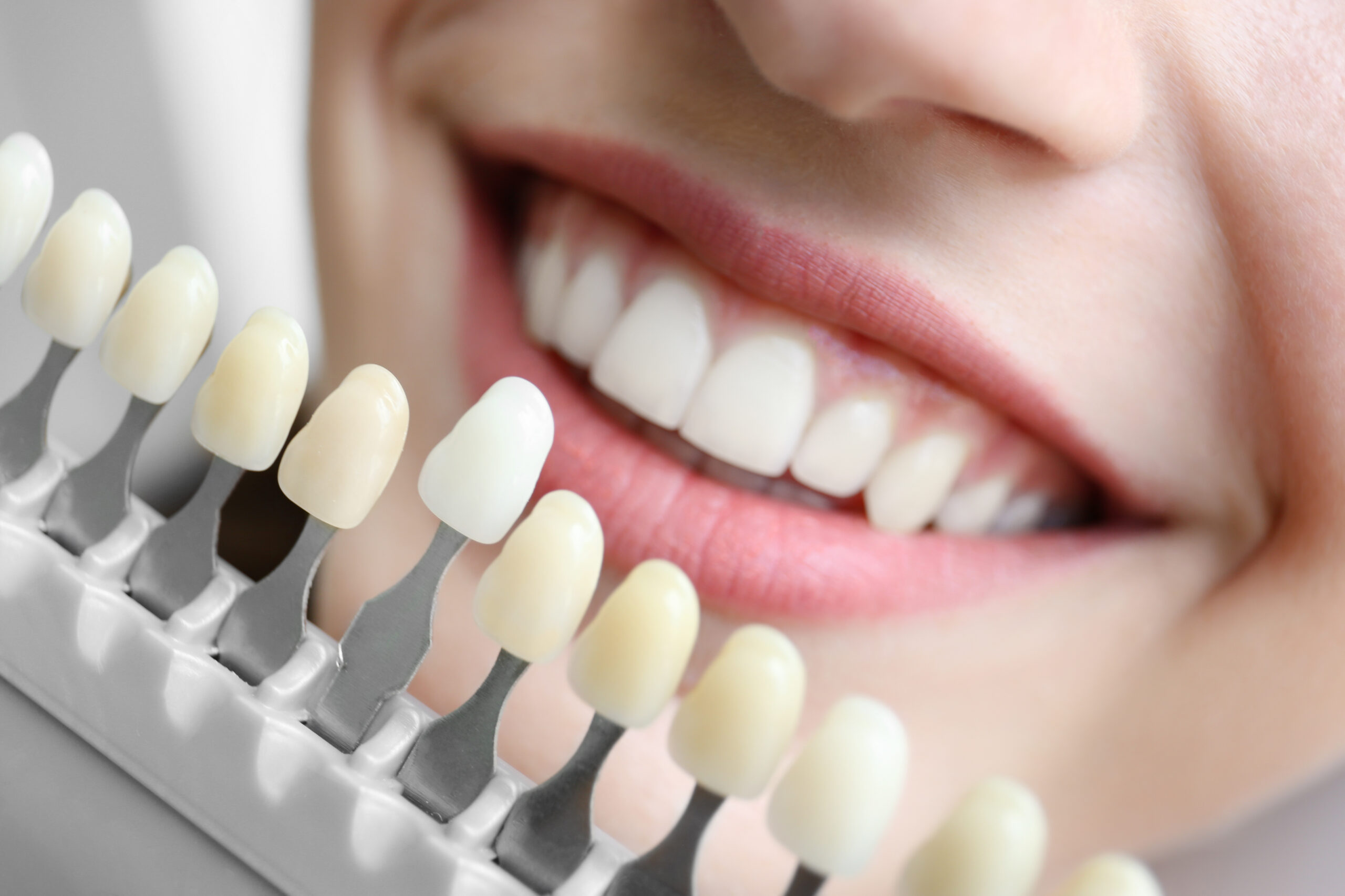 Young woman comparing tooth shade samples at dental office