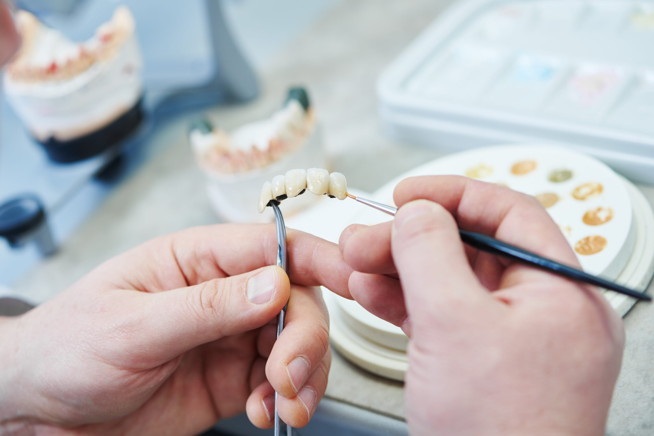 Ceramic dental crown restoration on a model of teeth